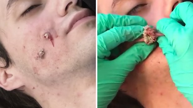 girl removing cyst from boyfriends face