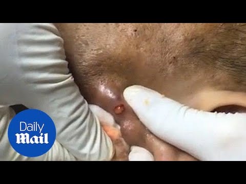 horrific zit pops