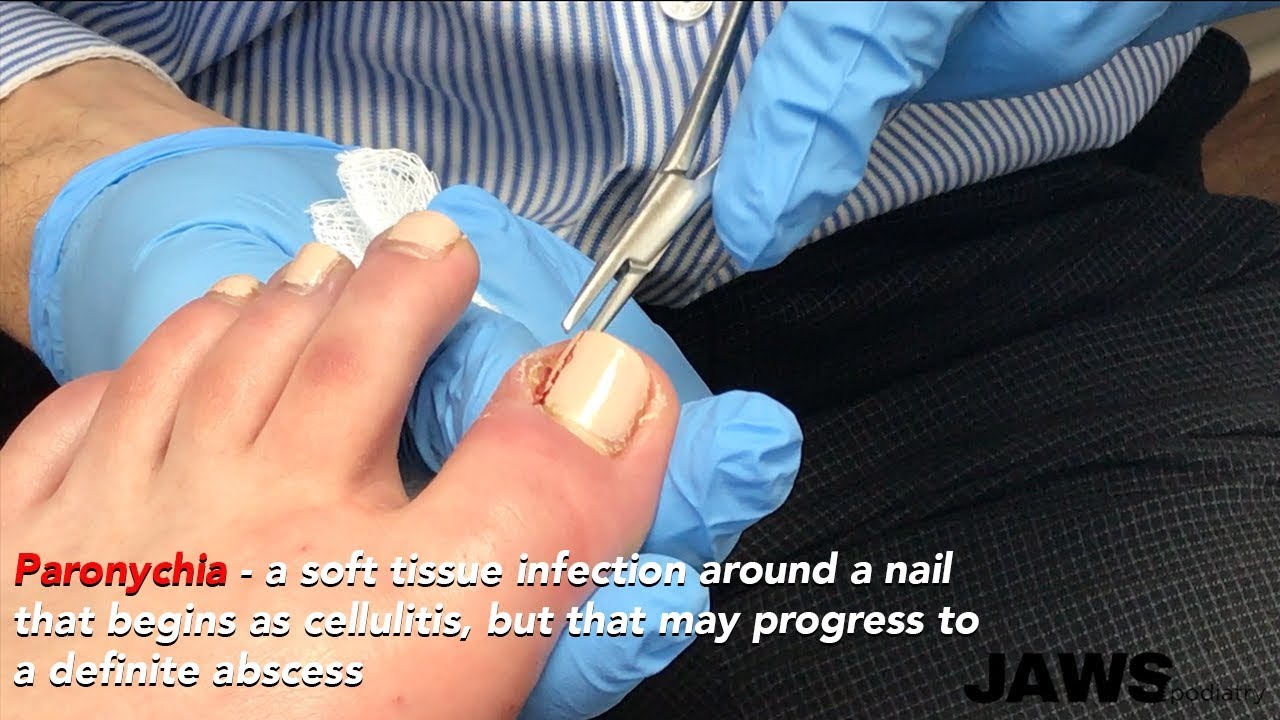 how to remove ingrown toenail youtube