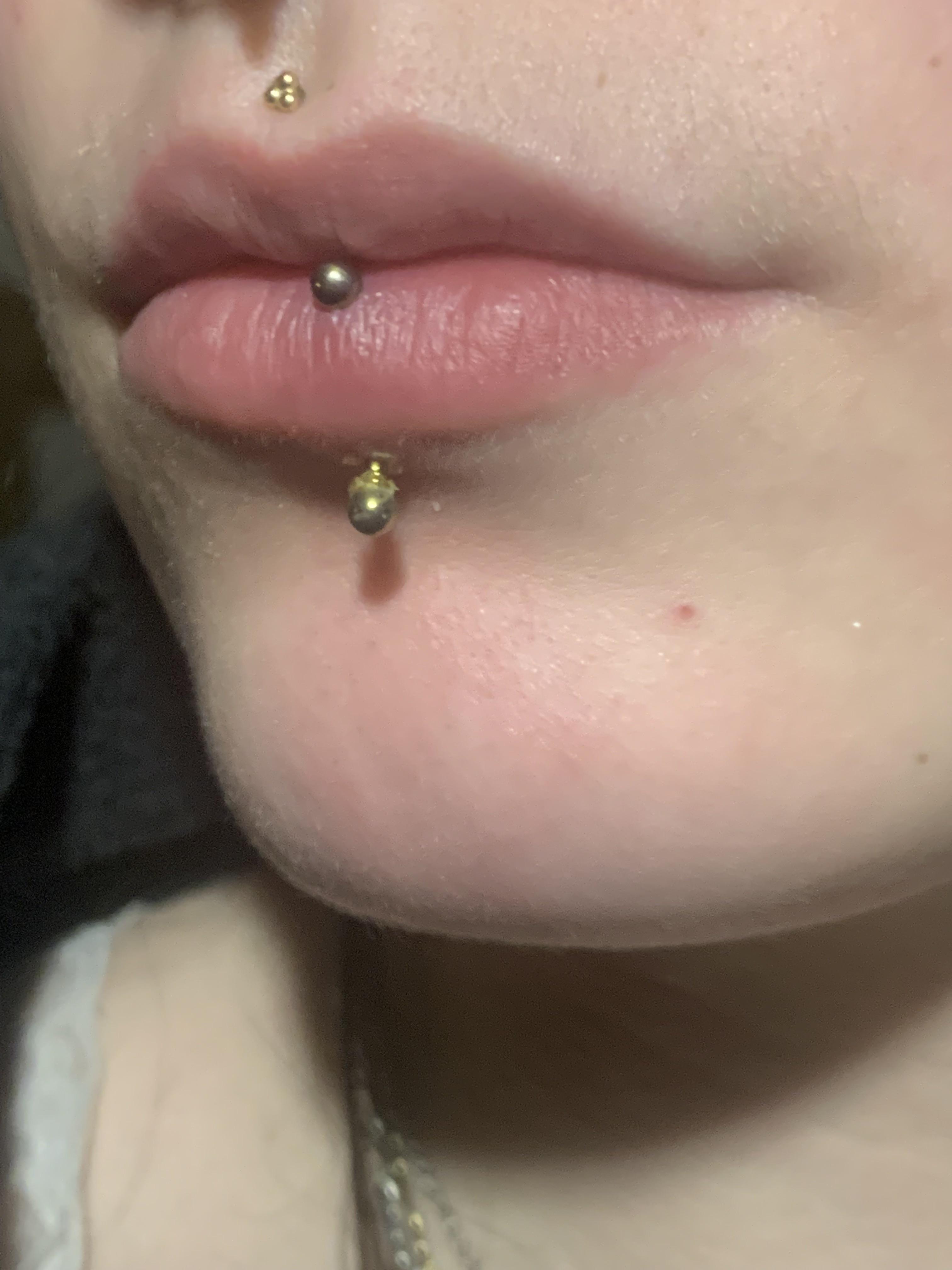 infected vertical labret