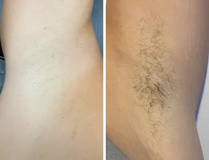 laser hair removal chatham kent