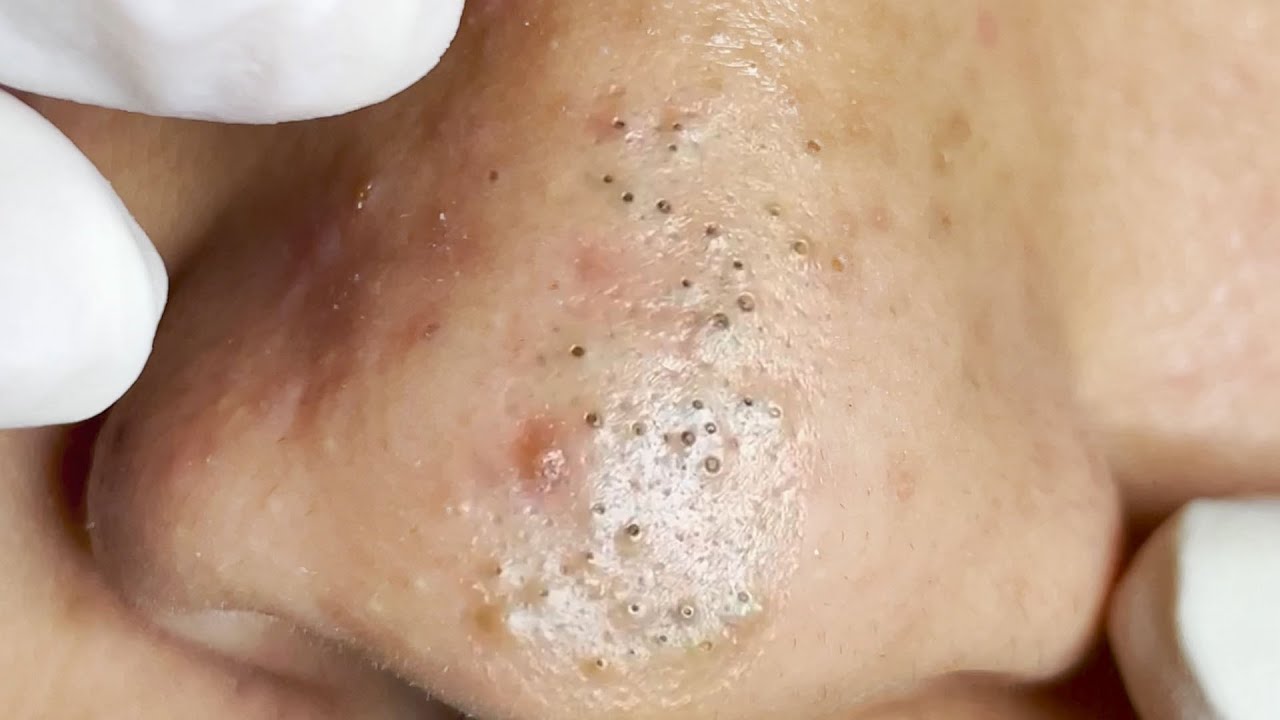 massive blackheads on nose and lips 2022