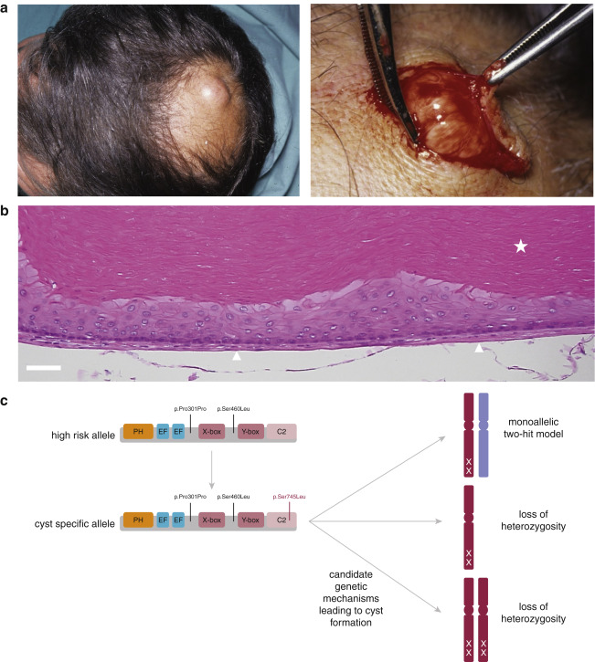 pilar cyst diagram