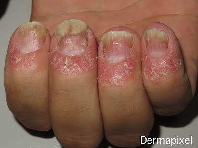 pintar uñas con psoriasis