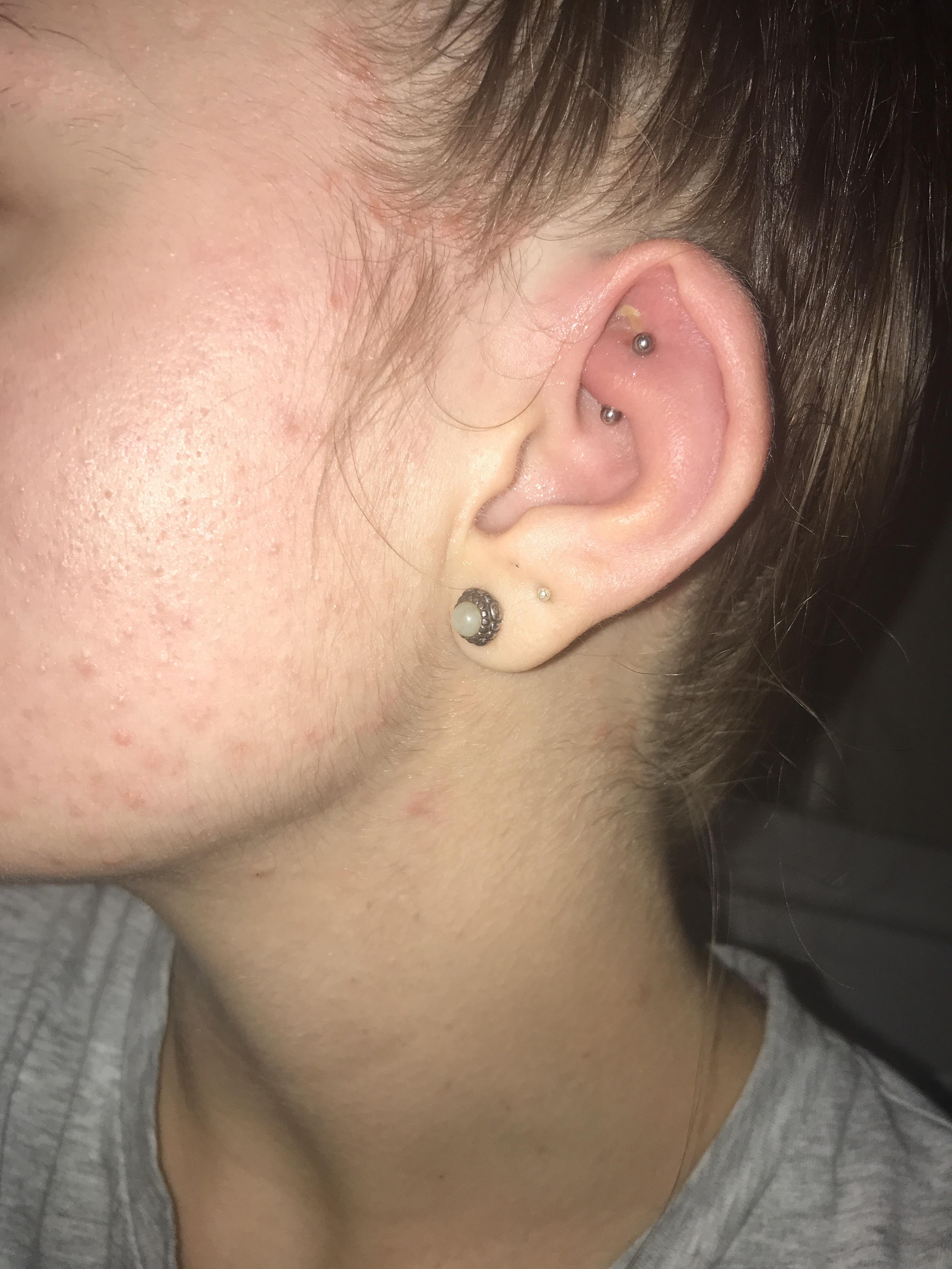 rook piercing infection