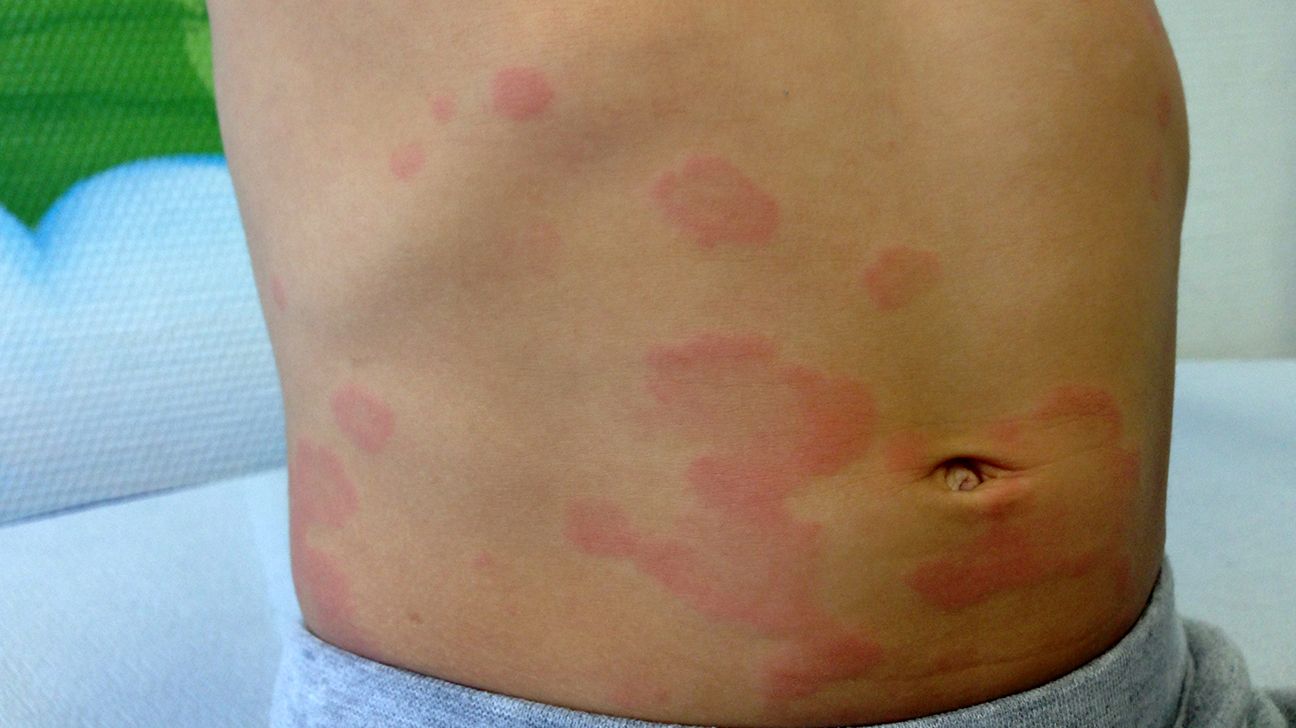 thyroid skin rash pictures face