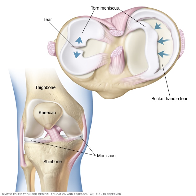 torn meniscus icd 10