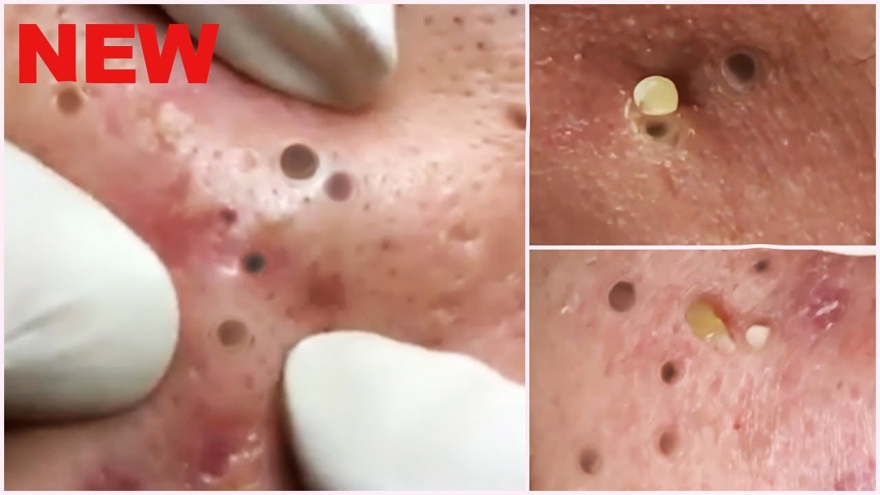 worst blackheads removal